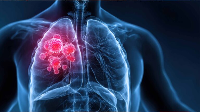 lungenkrebs ct